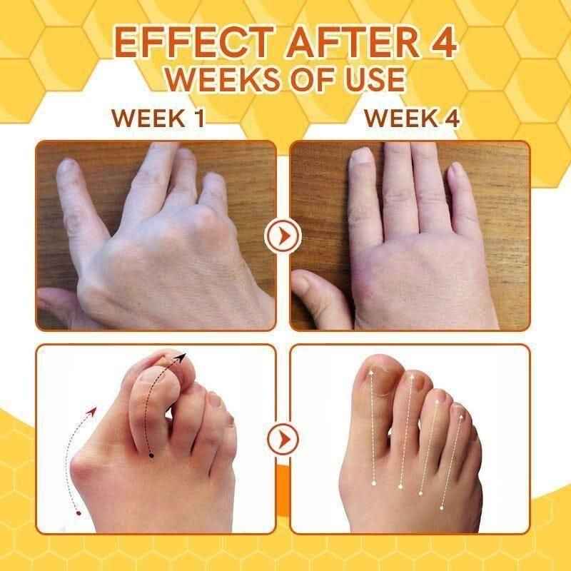 Bee Venom Spider Veins Spray - Vitamin K2 Varicose Vein Treatment (Pack of 2)